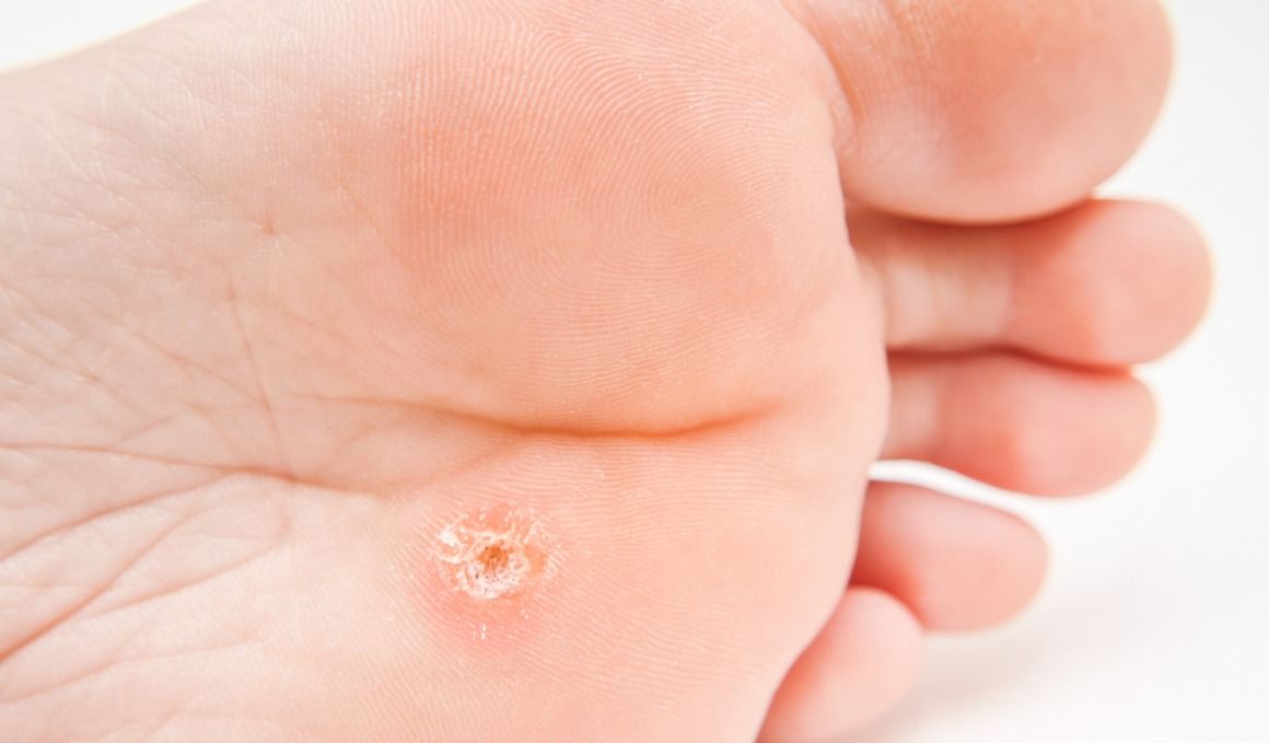 El papiloma en los pies no suele ser contagioso.