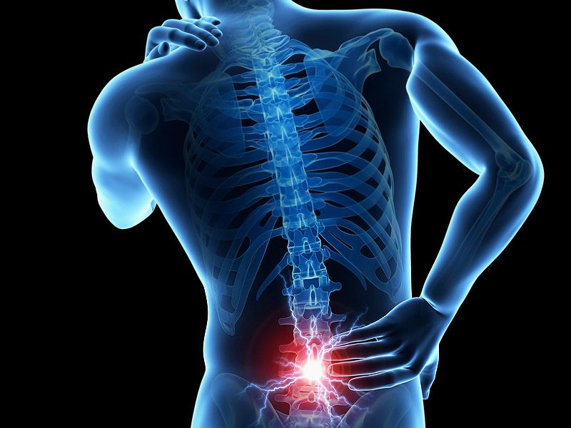 Recuperación de una hernia de disco