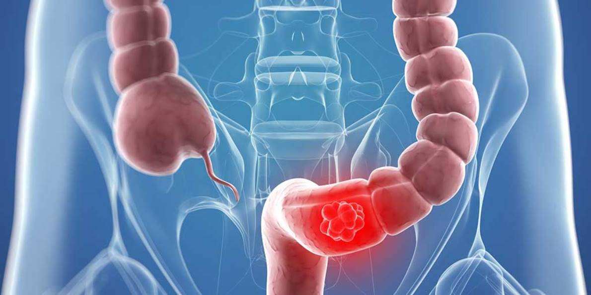 Alimentación para prevenir el cáncer de colón