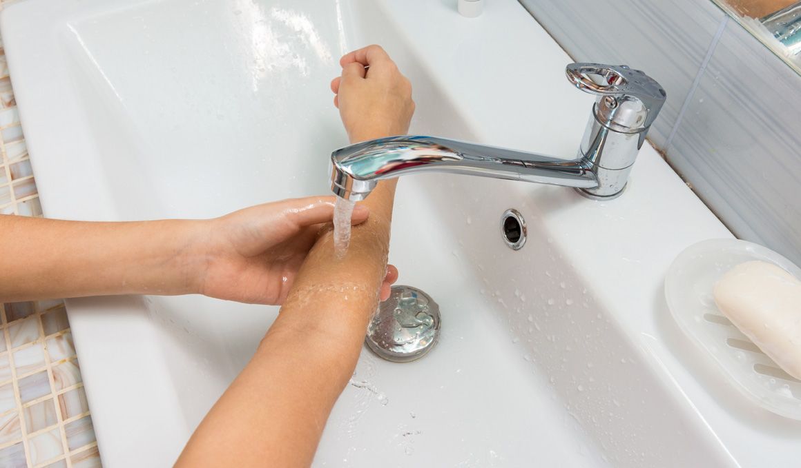 ¿Qué hacer en caso de quemadura? Agua fría al menos 20 minutos