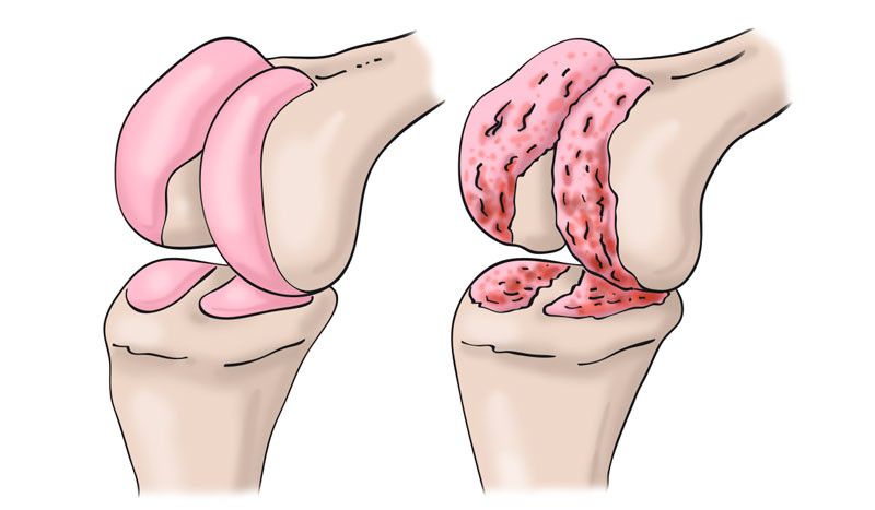 Artrosis de rodilla, ¿cuáles son sus causas y el tratamiento para recuperarme?