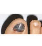 Salud deportiva: evita las uñas negras