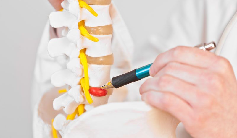 Consejos para tratar una hernia discal