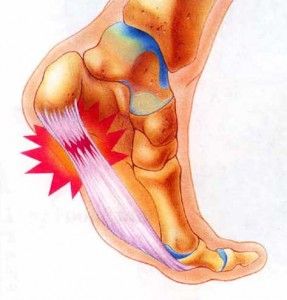 ¿Qué deporte puedo realizar para rehabilitar la fascitis plantar?