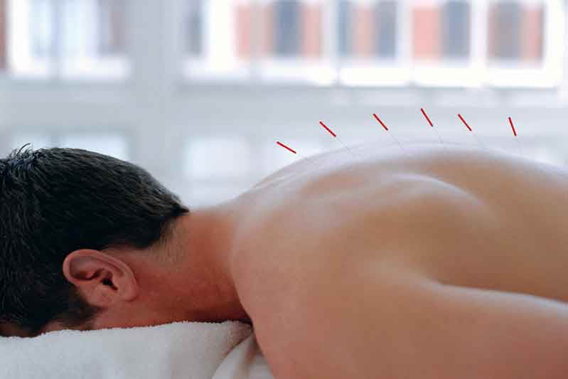 Acupuntura y deporte