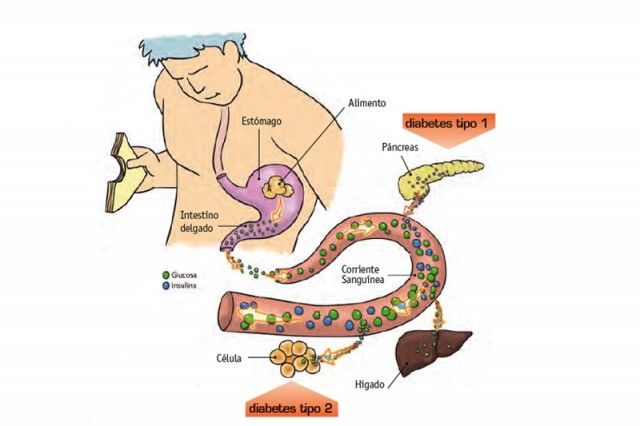 ¿Qué es la diabetes?