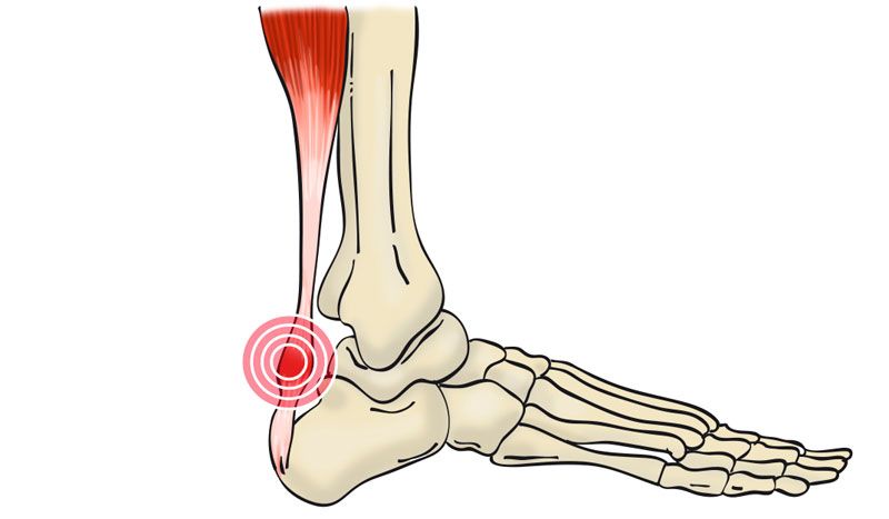 Tendinitis aquílea: cómo se produce y cómo nos recuperamos de esta lesión