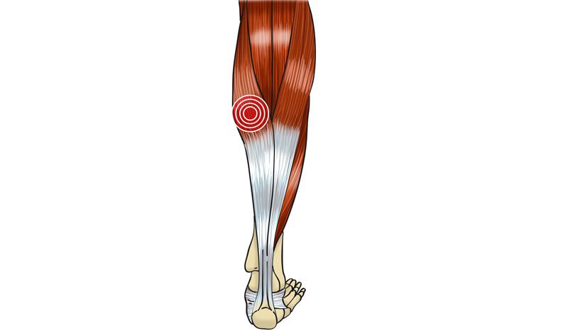 Desgarro muscular: cómo actuar y cómo recuperarnos tras esta lesión