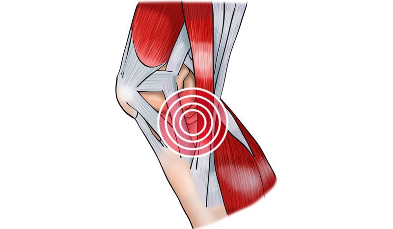 Tendinitis de la pata de ganso: ¿qué es y cómo me puedo recuperar de esta lesión?
