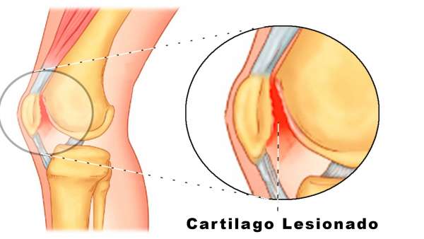 Ejercicios para fortalecer en casos de condromalacia