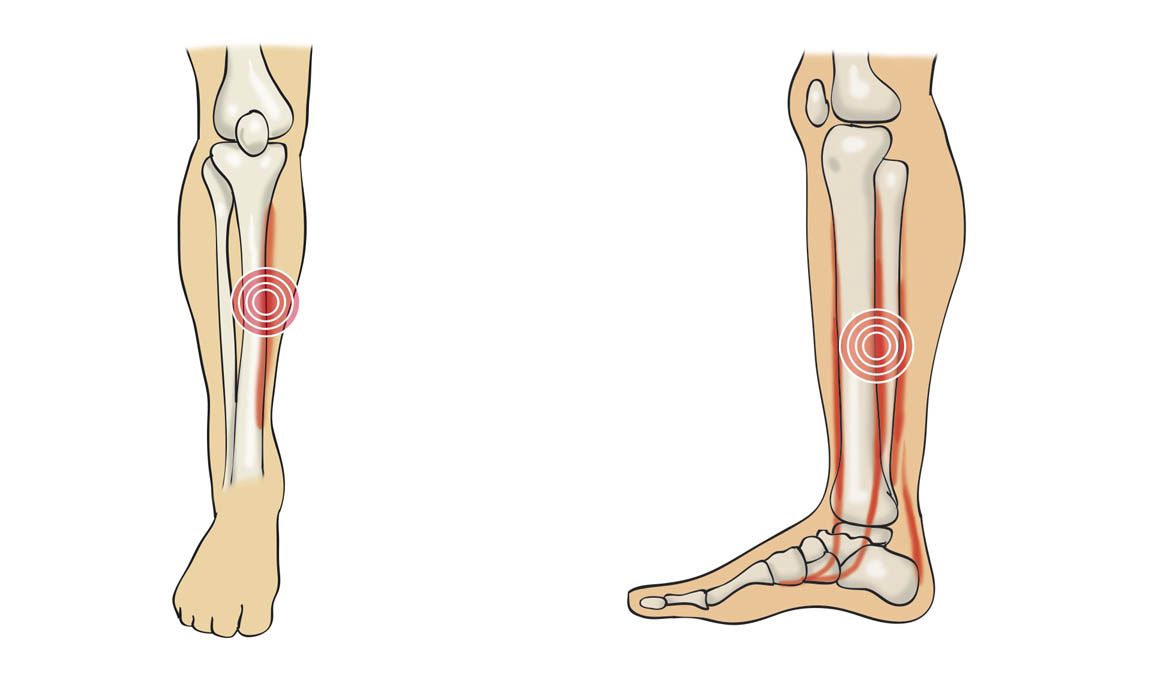 Periostitis tibial: cómo se produce y cómo nos recuperamos de esta lesión