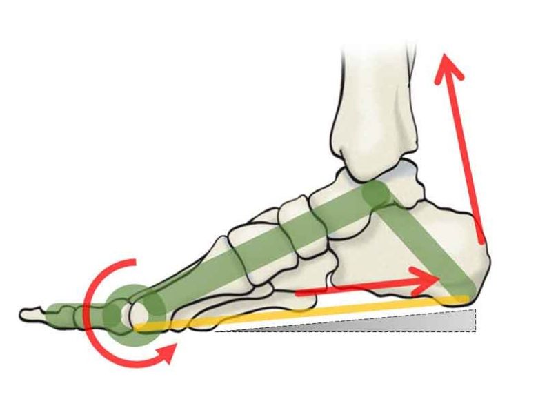 Fascitis plantar, una de las lesiones más temidas por los deportistas, en especial por los corredores