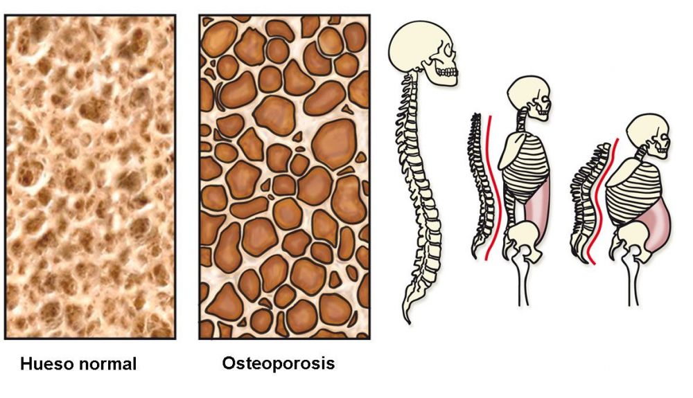 El fenómeno de la osteoporosis