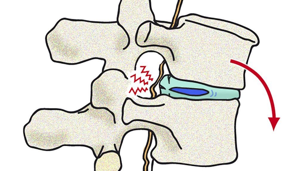 Protusión vertebral Protusión vertebral