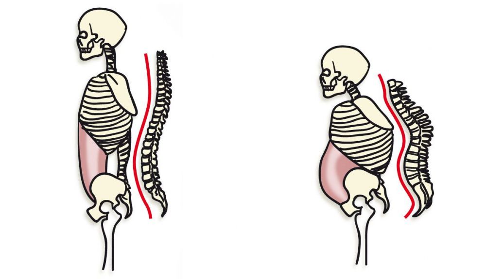 Osteoporosis Osteoporosis