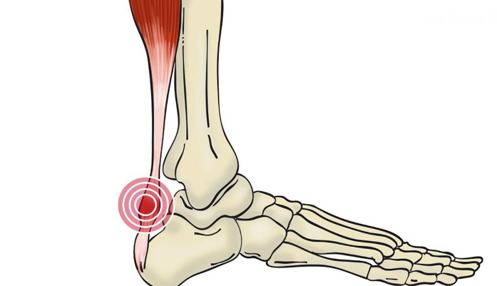 Tendinitis Aquiles