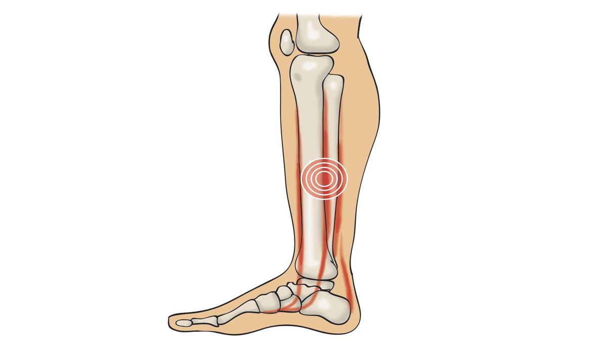 Periostitis tibial Periostitis tibial
