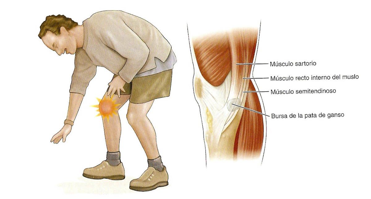 tendinitis pata de ganso