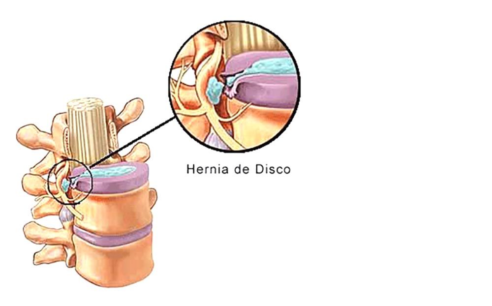 hernia1