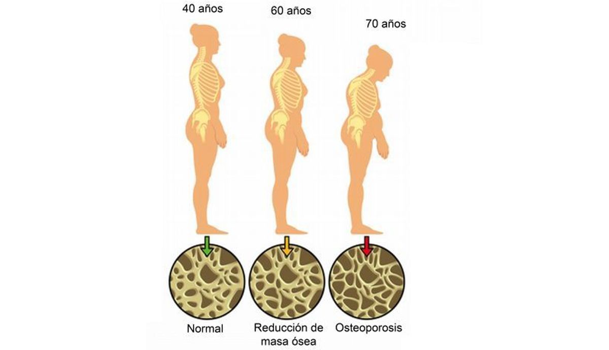 Evita la osteoporosis con ejercicio y dieta