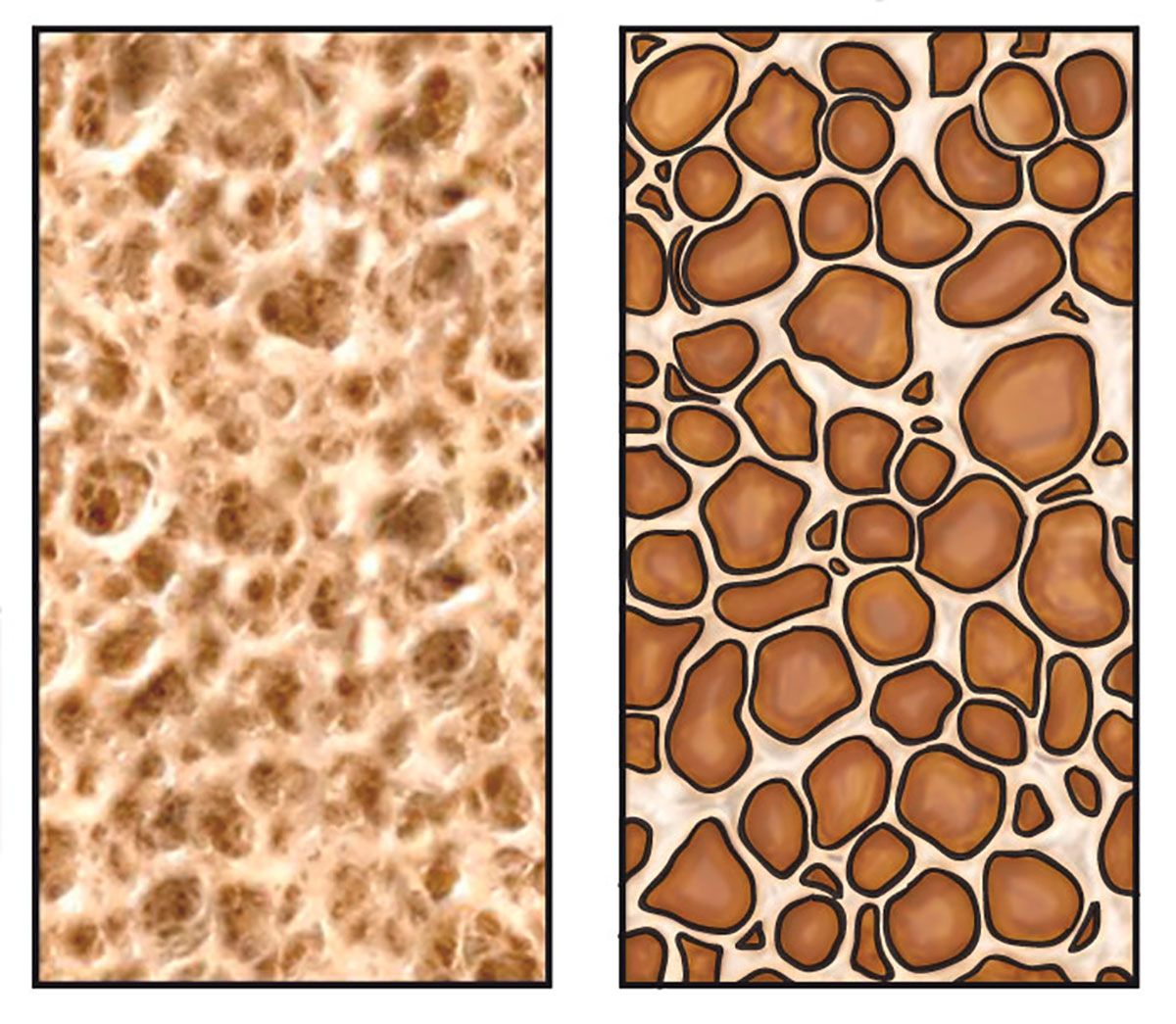 osteoporosis hueso osteoporosis hueso