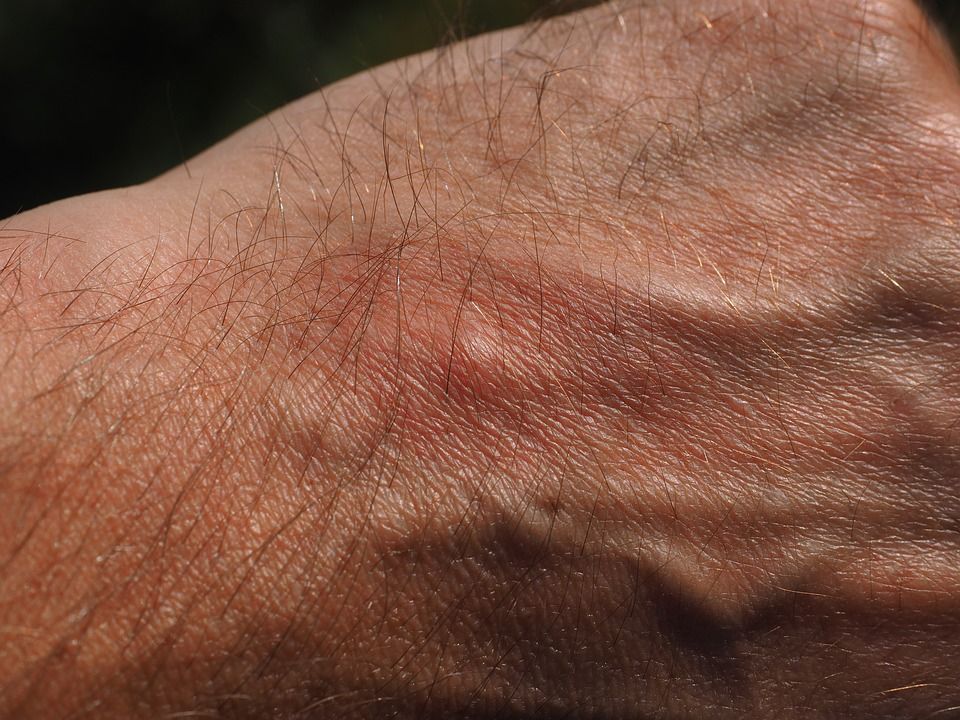 mosquito bite 2117421 960 720 mosquito bite 2117421 960 720