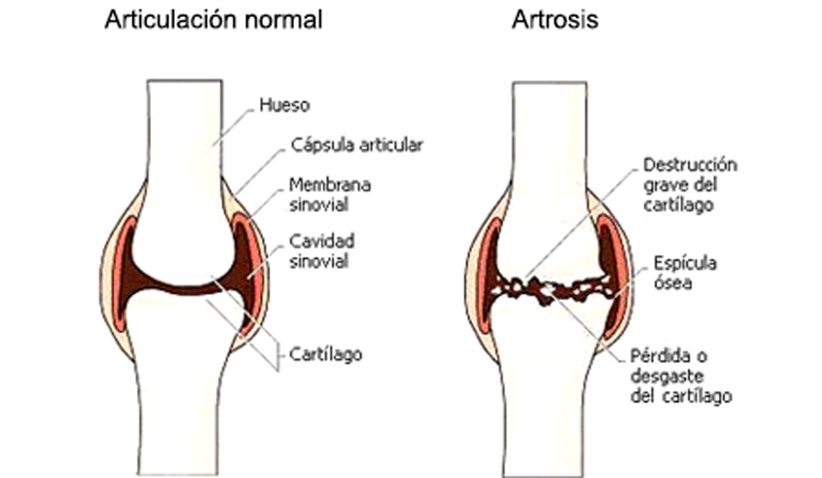 Diferencias entre artrosis y artritis