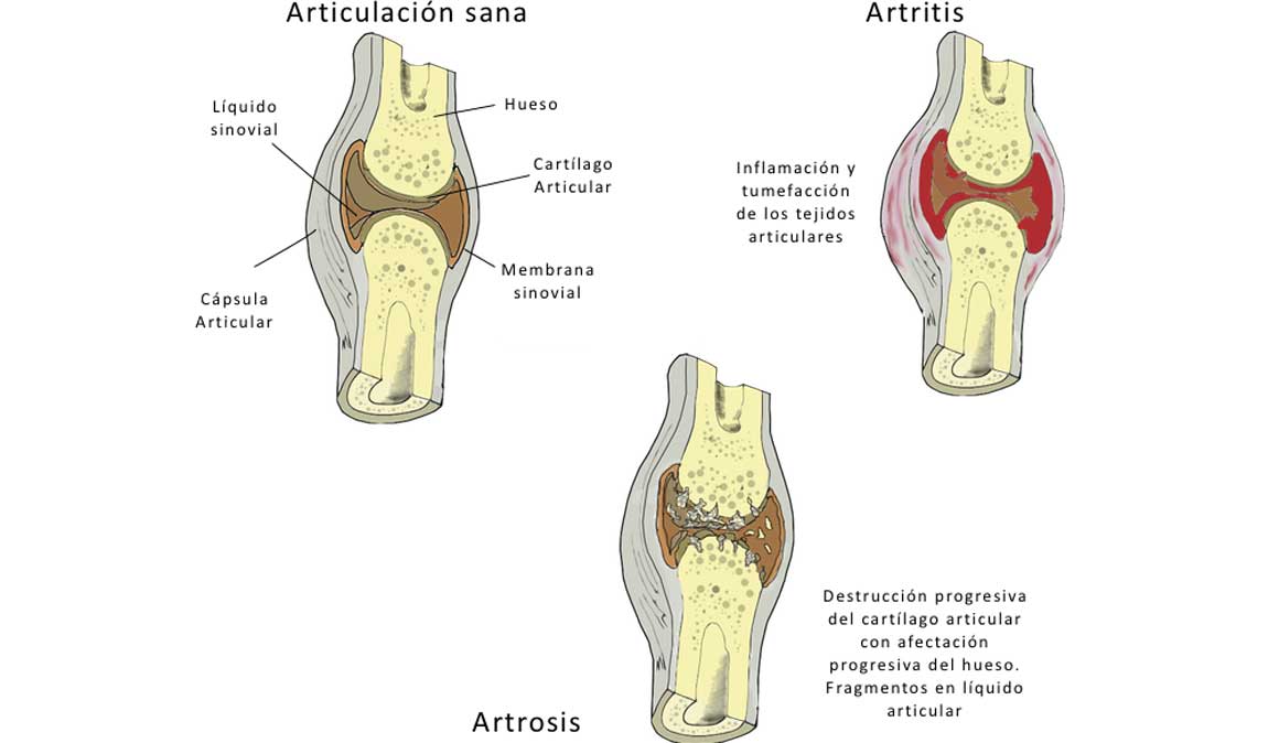 Diferencias entre artrosis y artritis