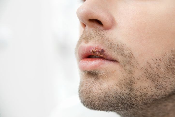 ¿Cómo se contagia el herpes labial?