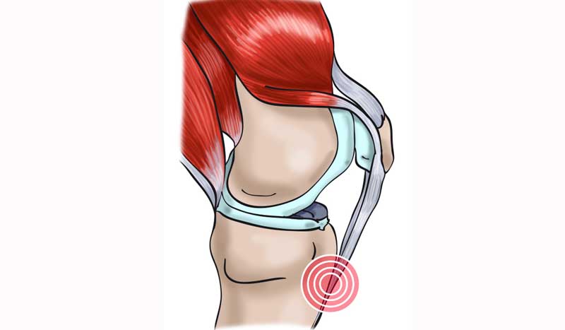 Tendinitis rotuliana: así se produce y así nos podemos recuperar de esta lesión