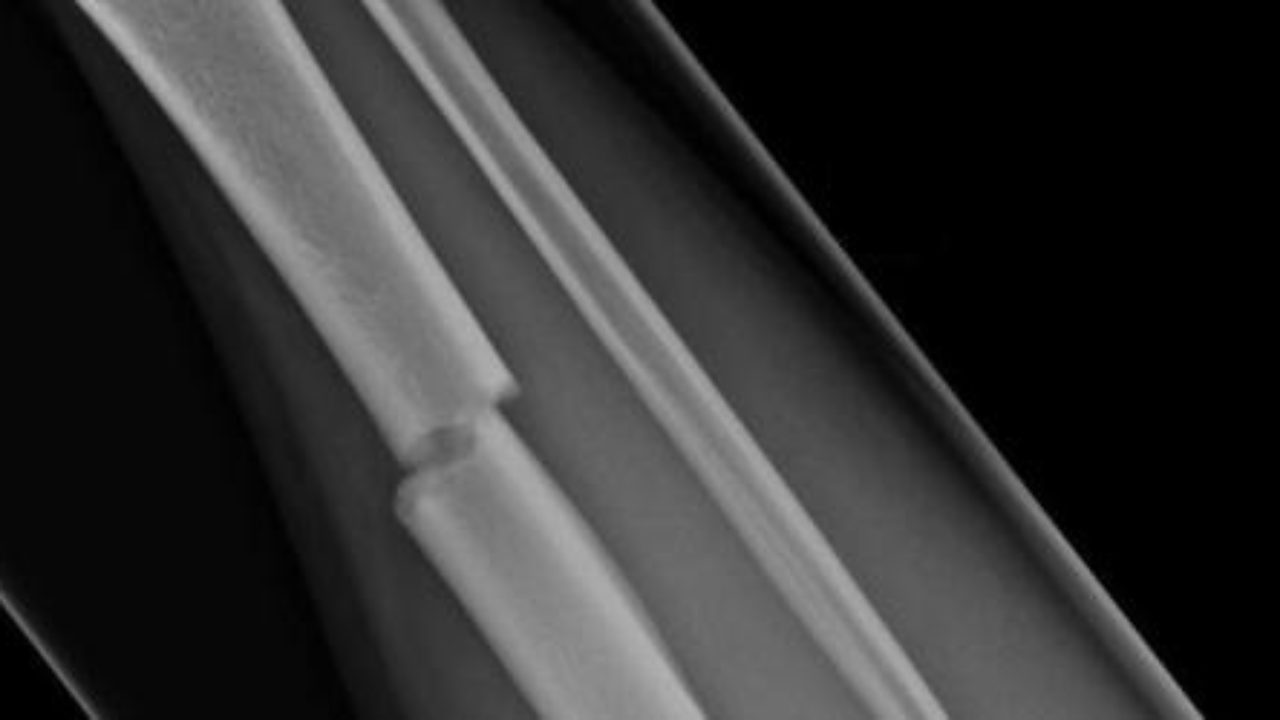Lesiones deportivas: fracturas óseas
