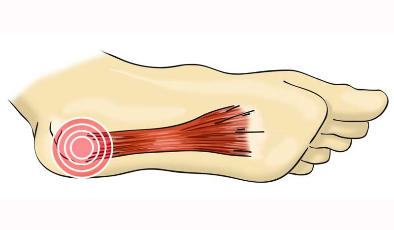 Lesiones del deporte: fascitis plantar