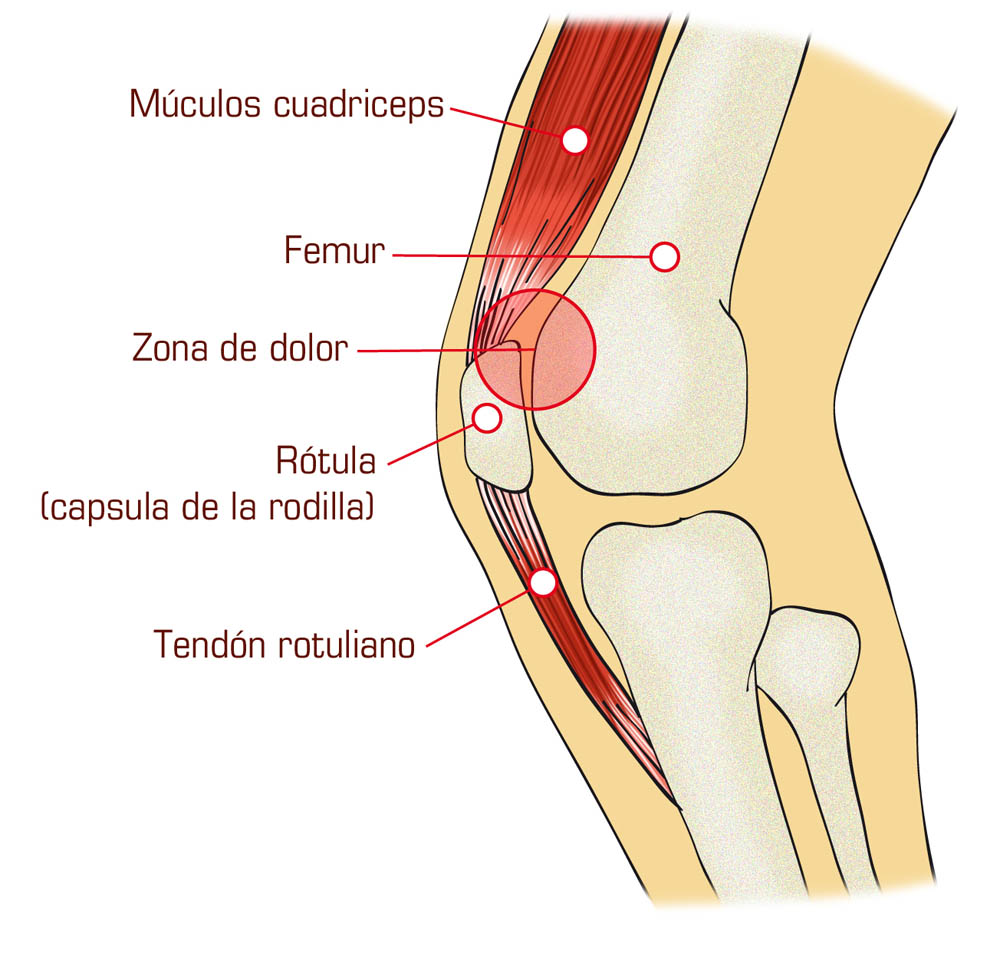 Cúrate de la rodilla del corredor